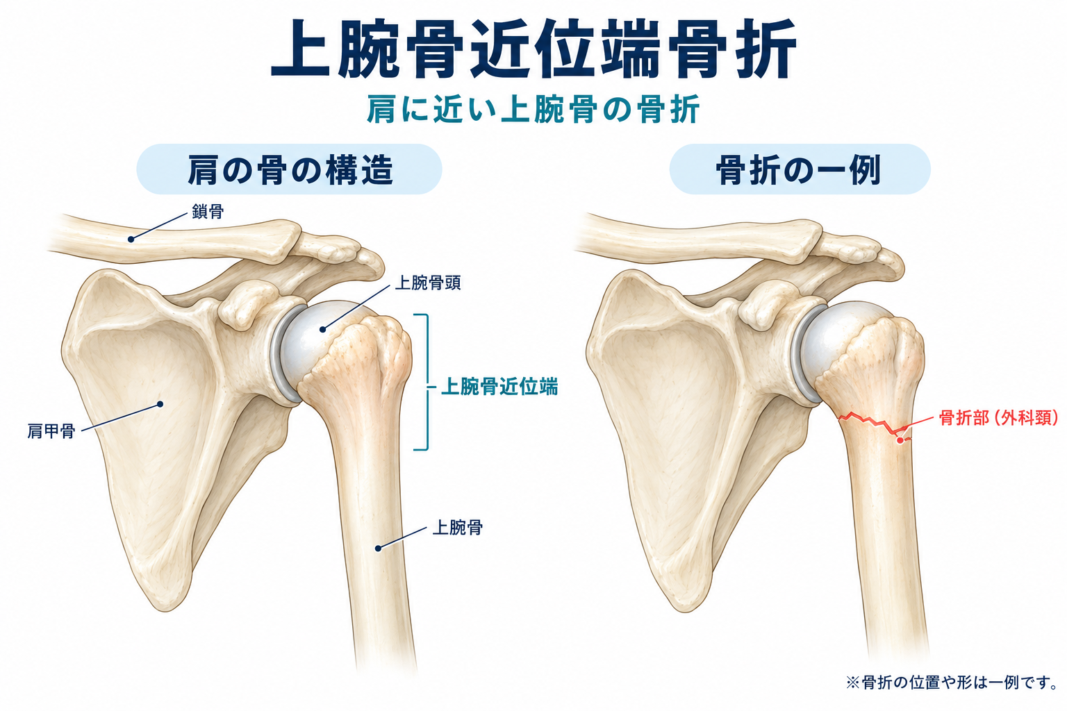 交通事故で上腕骨近位端骨折した場合の後遺障害-肩が上がらない・痛みが残ったら何級？-