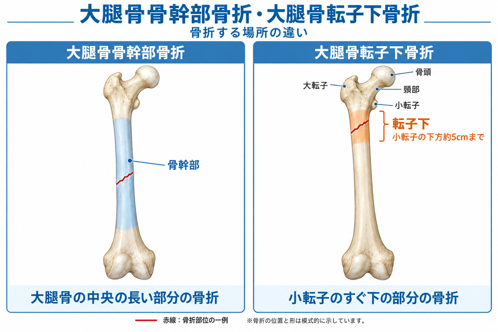 大腿骨骨幹部骨折と大腿骨転子下骨折の部位を比較した解剖模式図