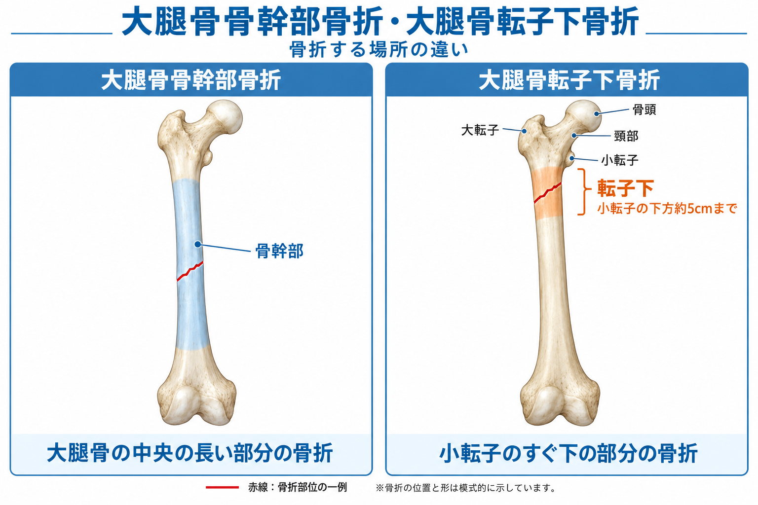 交通事故による大腿骨骨幹部骨折・転子下骨折で残りやすい症状は？後遺障害は何級になる？