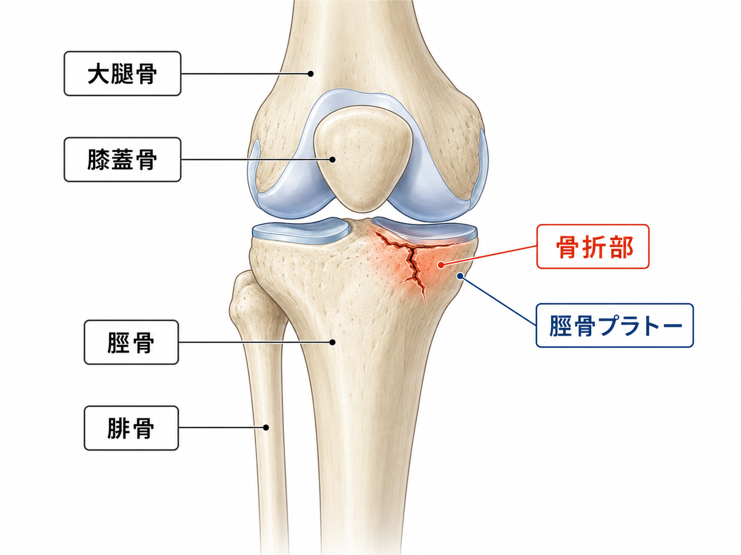 脛骨プラトー骨折で膝の痛み・曲げにくさが残ったら後遺障害は何級?