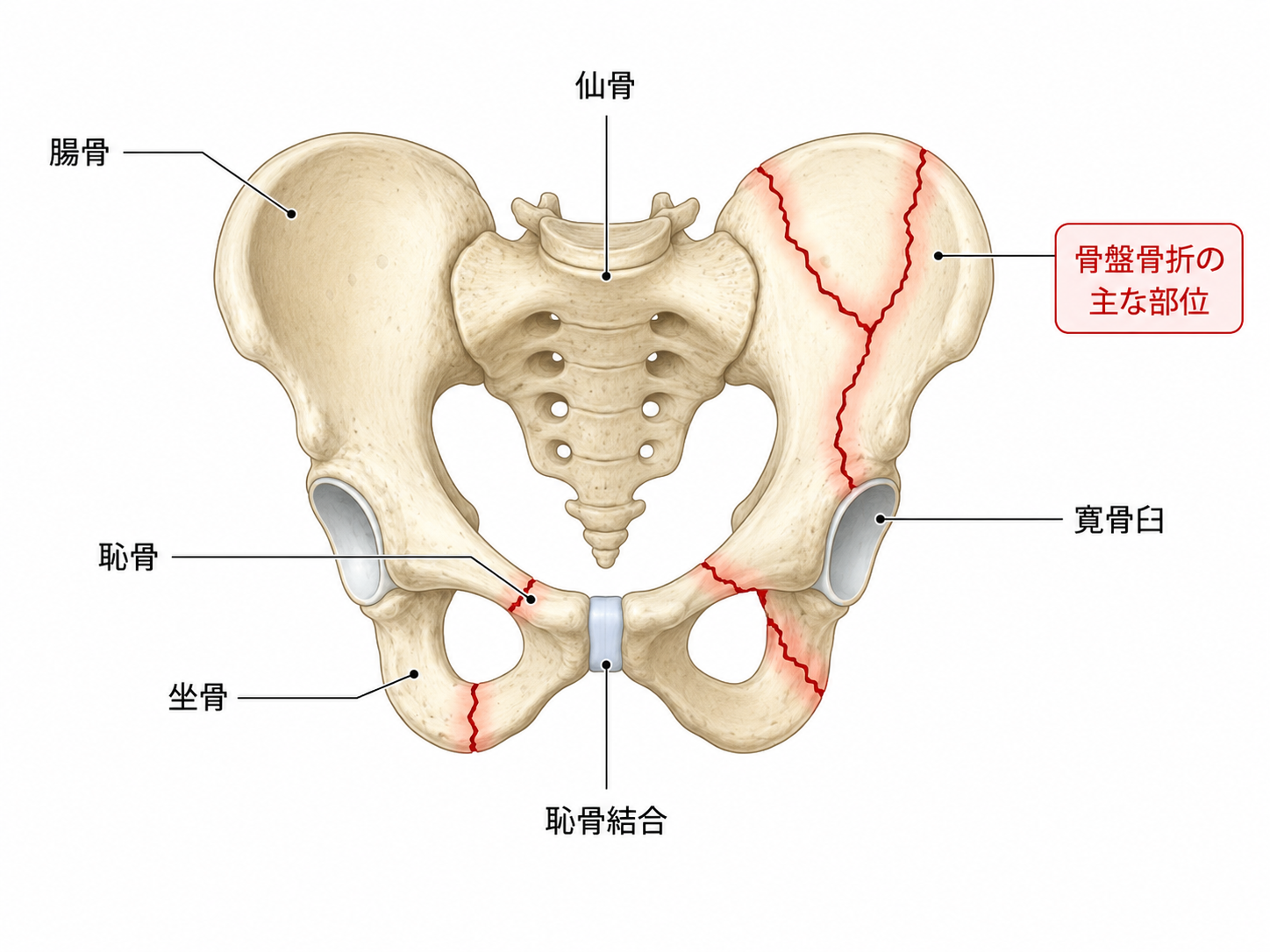 骨盤骨折で痛み・変形が残ったら後遺障害は何級?認定される等級とポイント