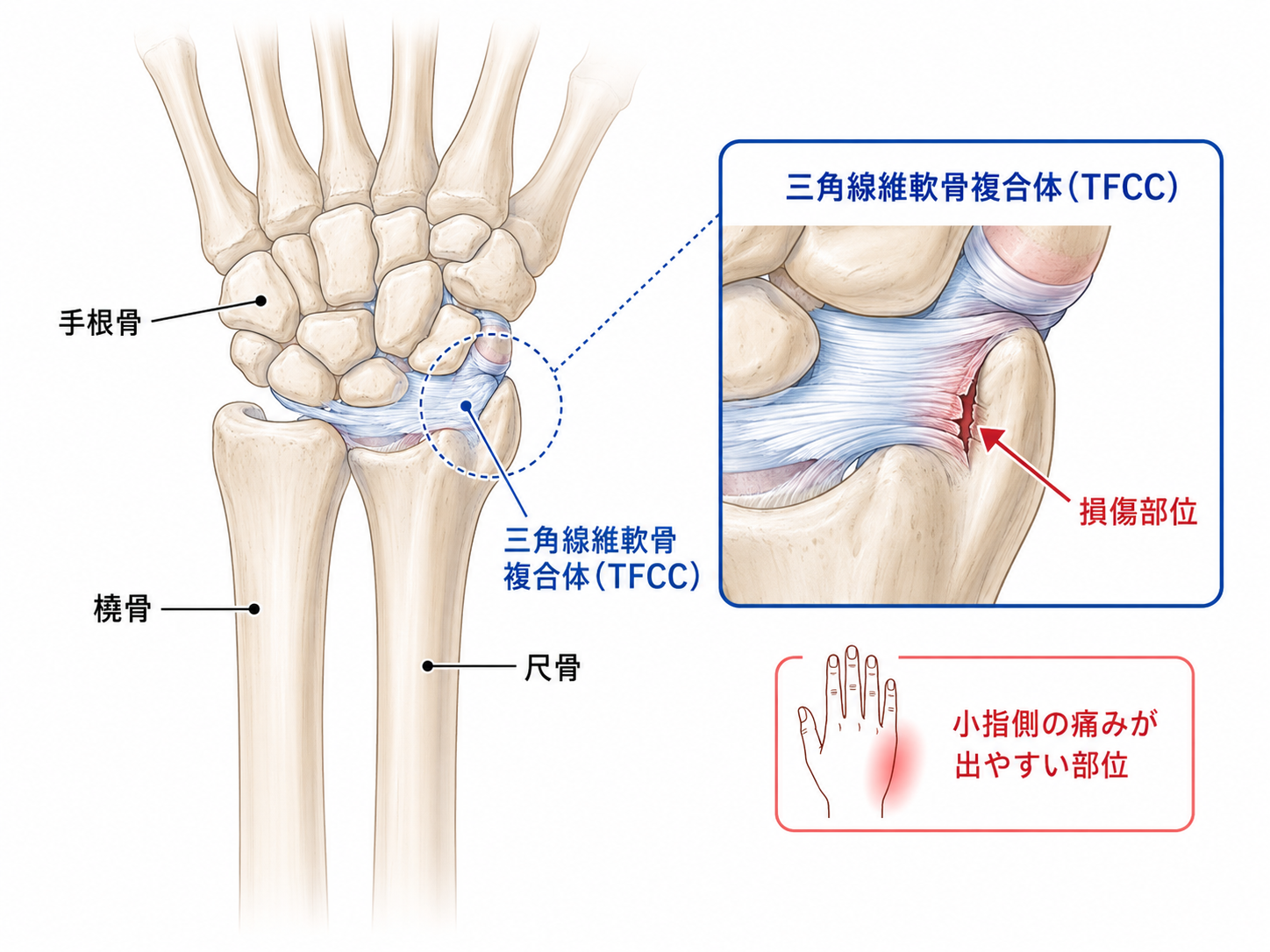 TFCC損傷で手首の痛みが残ったら後遺障害は何級?-12級13号・14級9号の可能性-