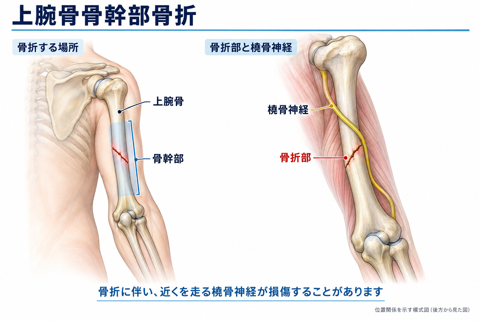 交通事故による上腕骨骨幹部骨折で痛み・変形・下垂手が残ったら何級？