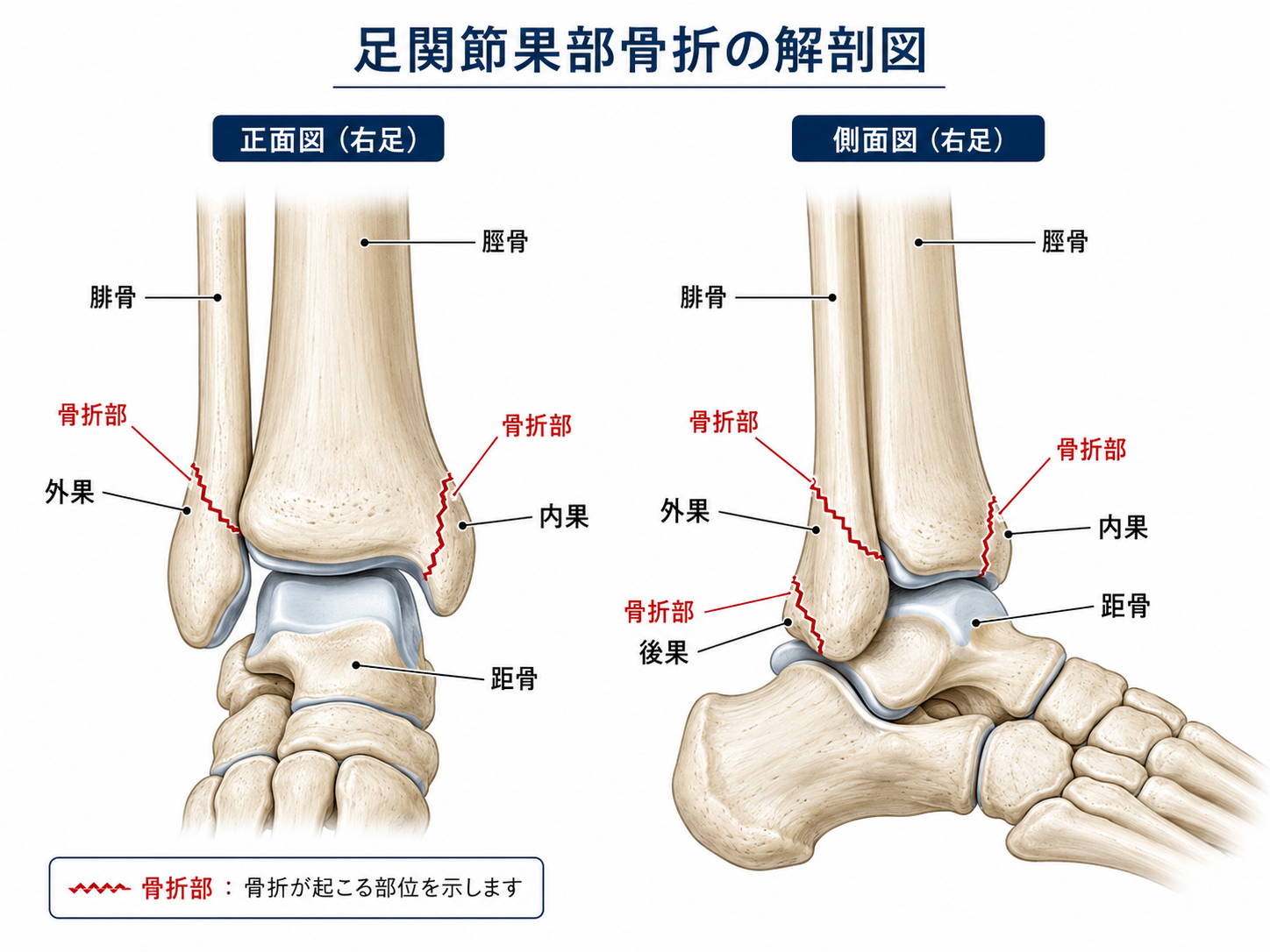 足関節果部骨折で残りやすい症状は？後遺障害は何級になる？