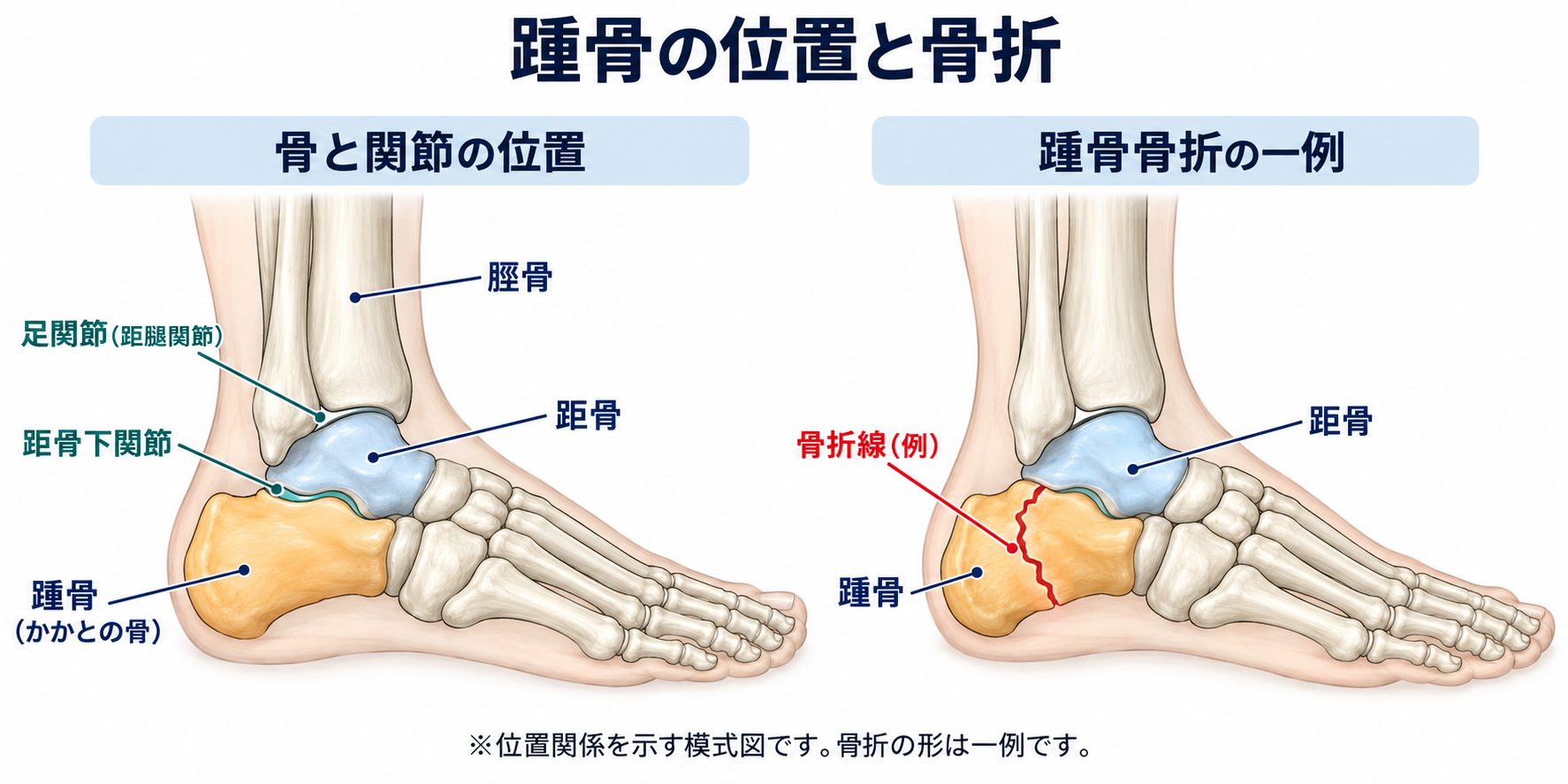 交通事故による踵骨骨折でかかとの痛み・歩きにくさが残ったら？後遺障害は何級になる？