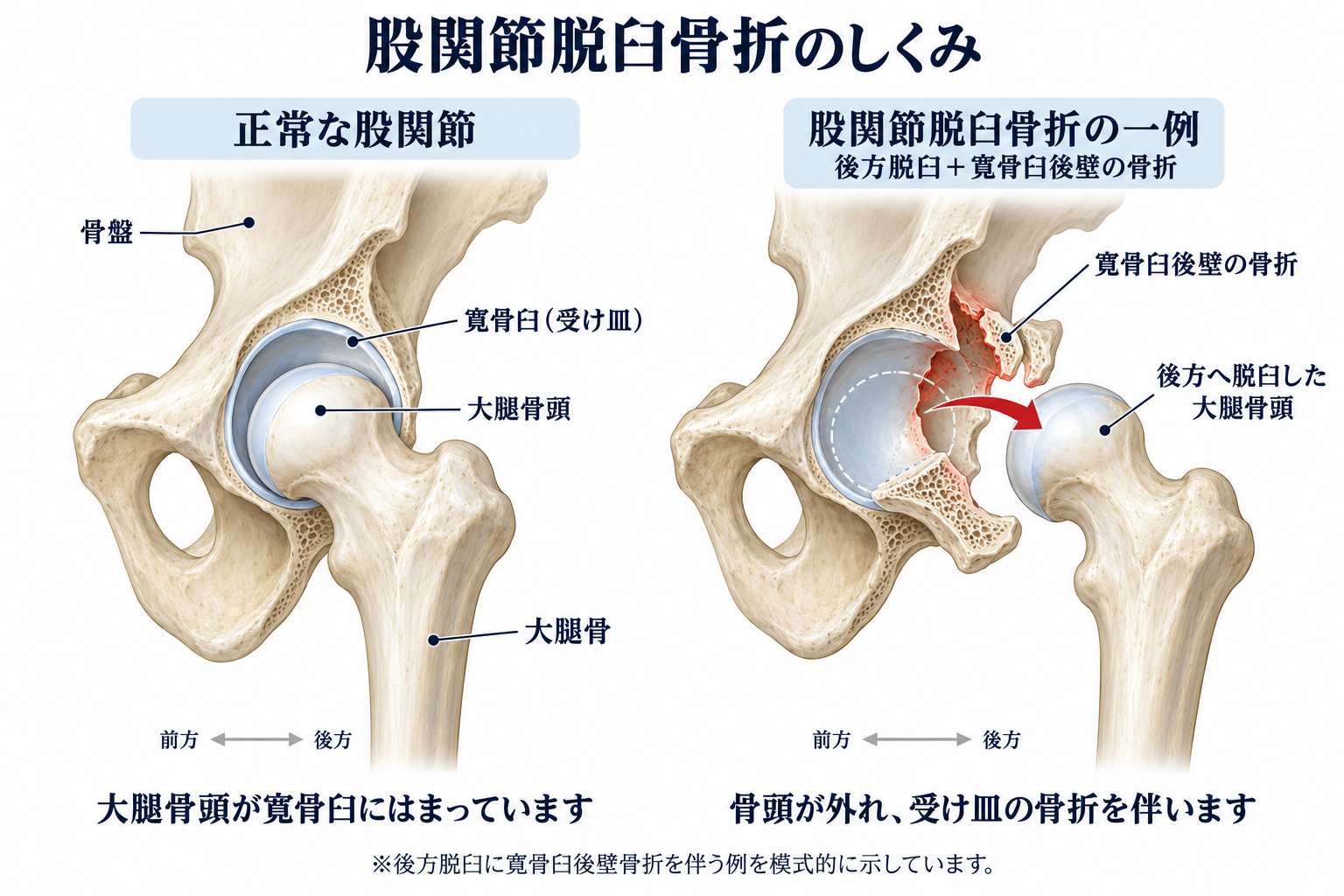 交通事故による股関節脱臼骨折で痛み・可動域制限が残ったら？後遺障害は何級になる？