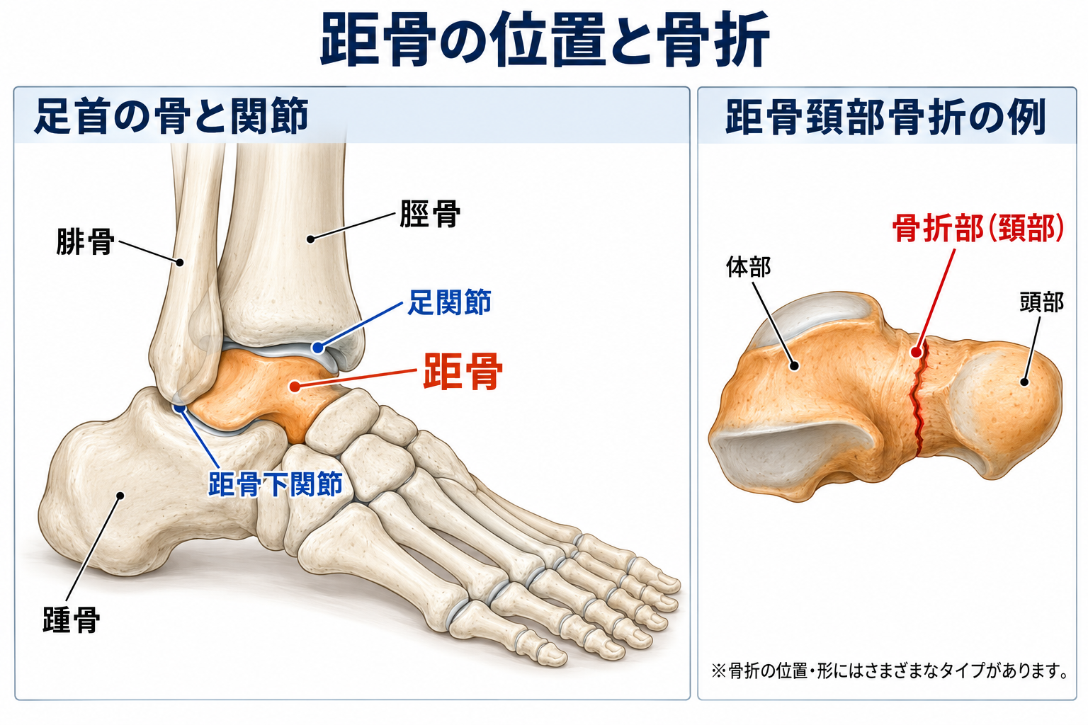 交通事故による距骨骨折で痛み・足首の動かしにくさが残ったら？後遺障害は何級になる？