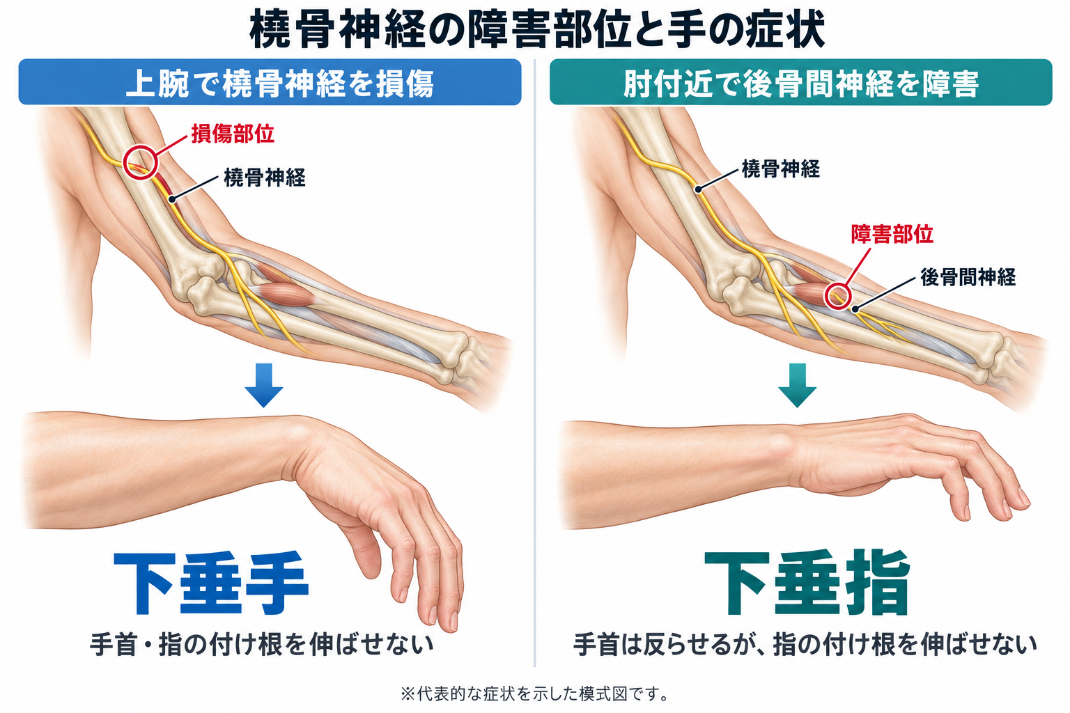 橈骨神経麻痺で下垂手・下垂指が残ったら何級？交通事故の後遺障害を解説
